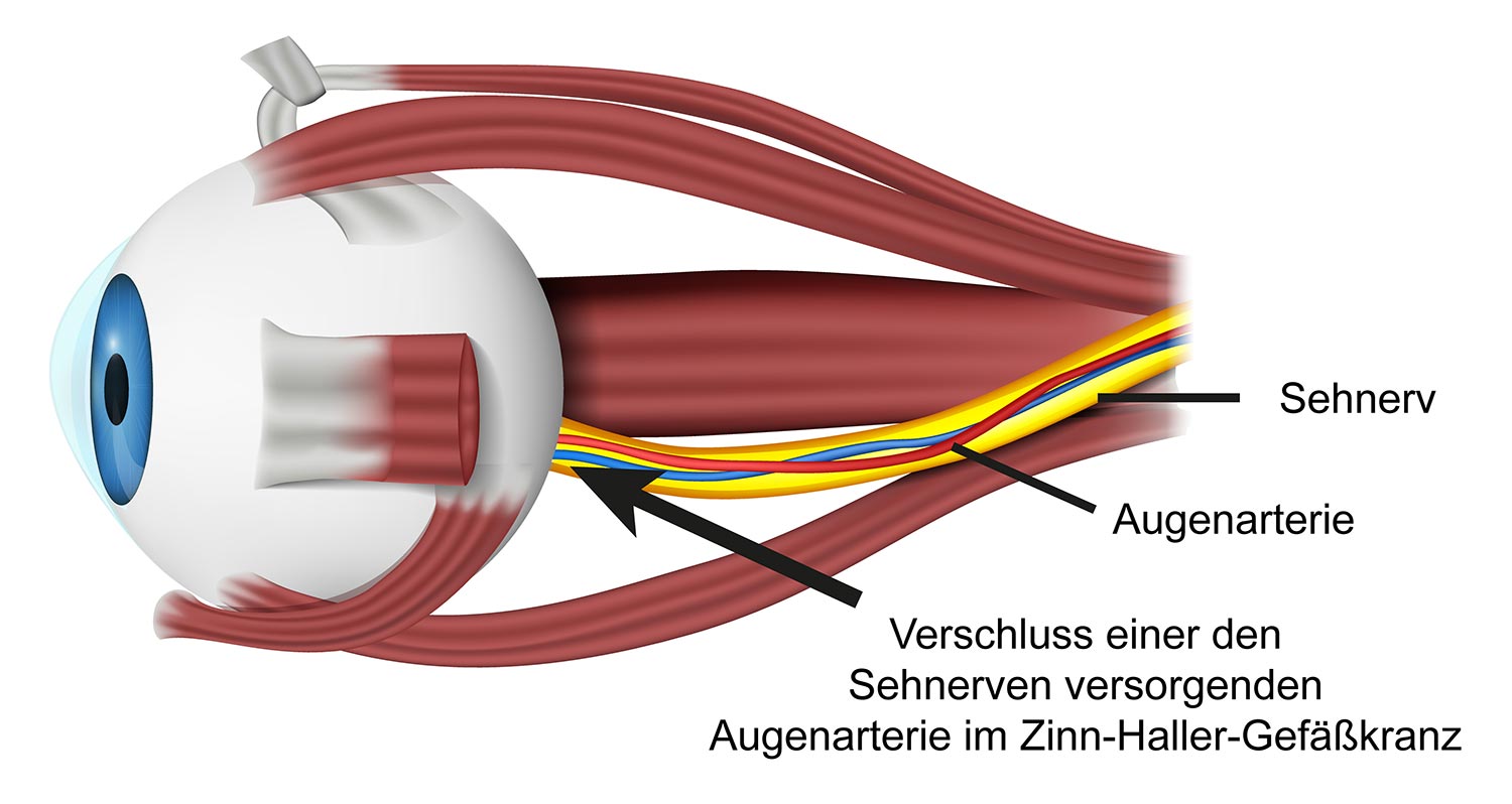 apoplexia-papillae-grafik