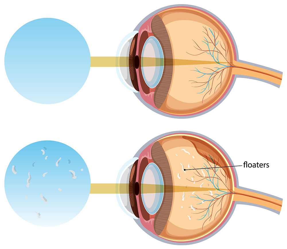 grafische-darstellung-floaters