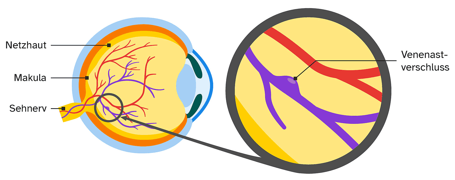 venenastverschluss-grafik
