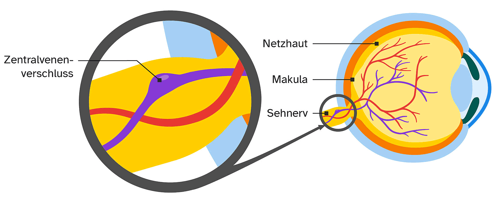 zentralvenenverschluss-grafik