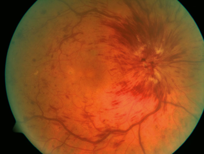 zentralvenenverschluss